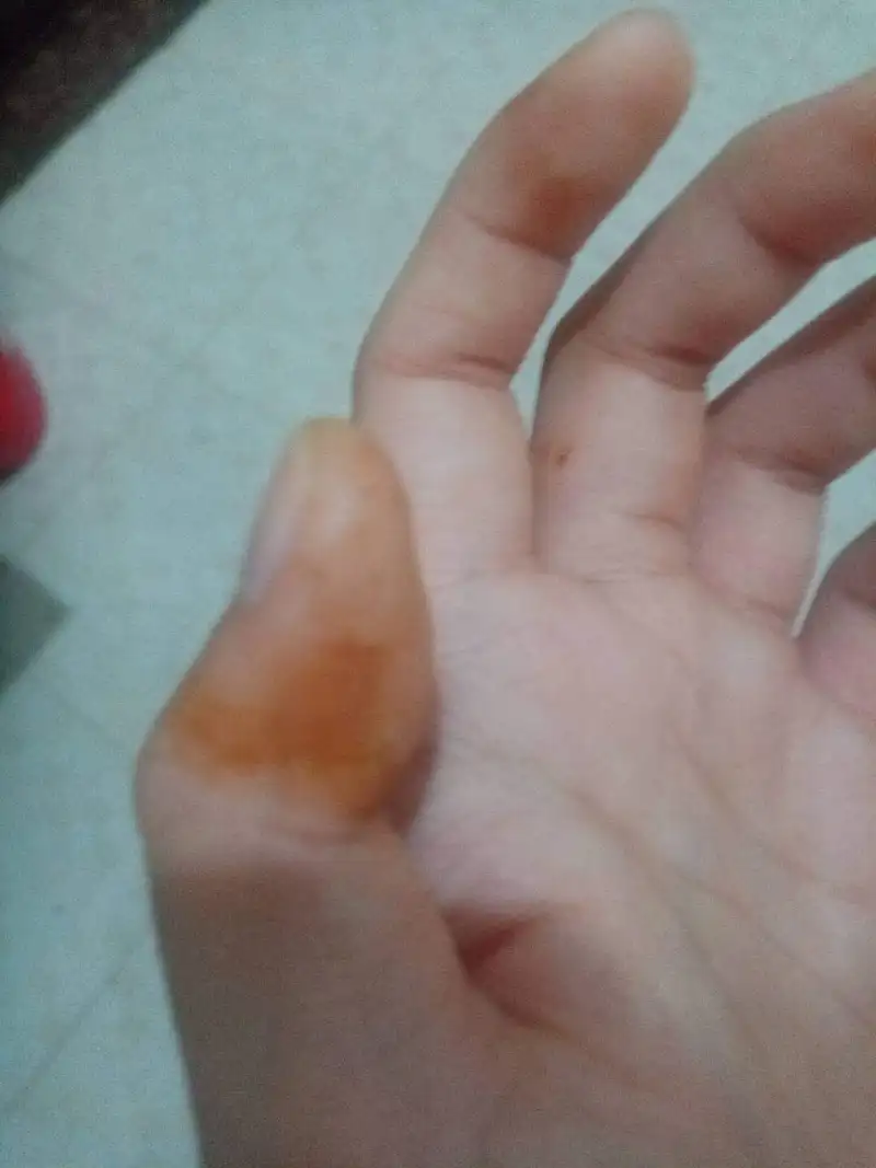 论刚起床手上为什么会有血